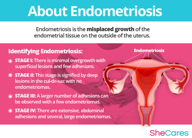 Endometriosis Pain Relief with Marijuana – HighClub