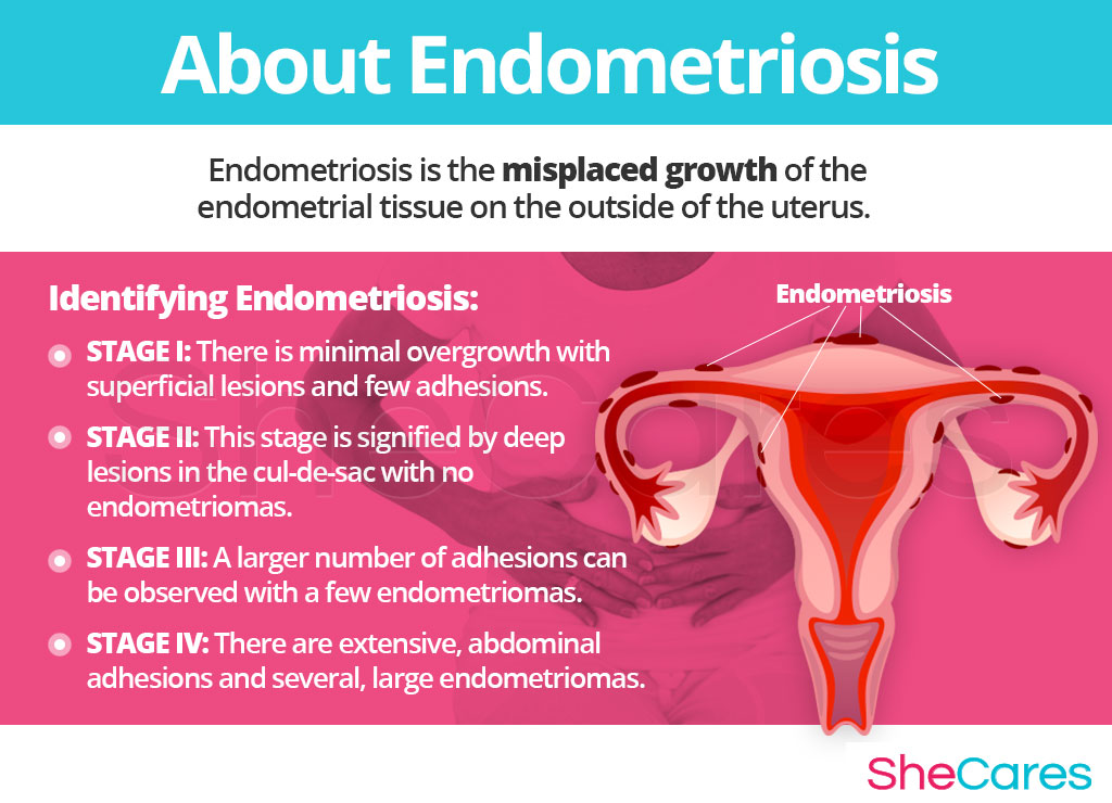 endometriosis pain relief with marijuana